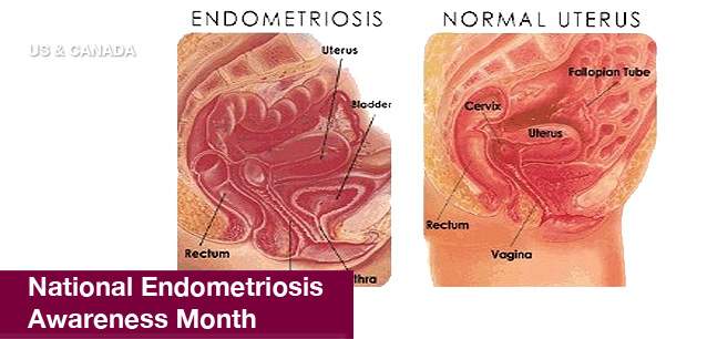No image found 4359_Endometriosis_Awareness_MonthE.png