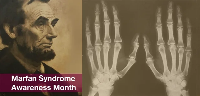 No image found 5330_Marfan_Syndrome_MonthE.webp