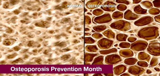 No image found 5743_Osteoporosis_Prevention_MonthE.png